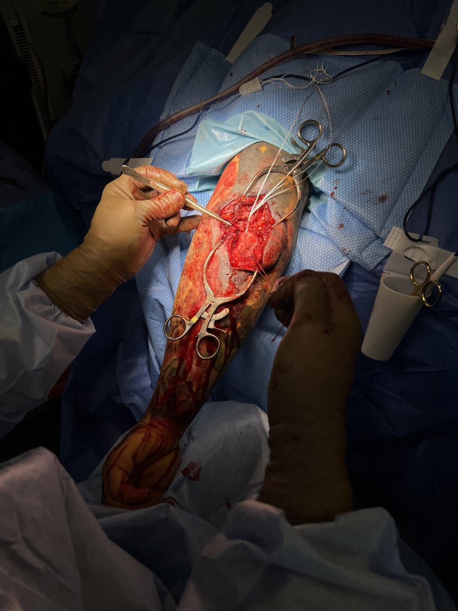 The triceps surgery (Courtesy of Josh Alexander)